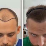 Best Hair Transplat Turkey