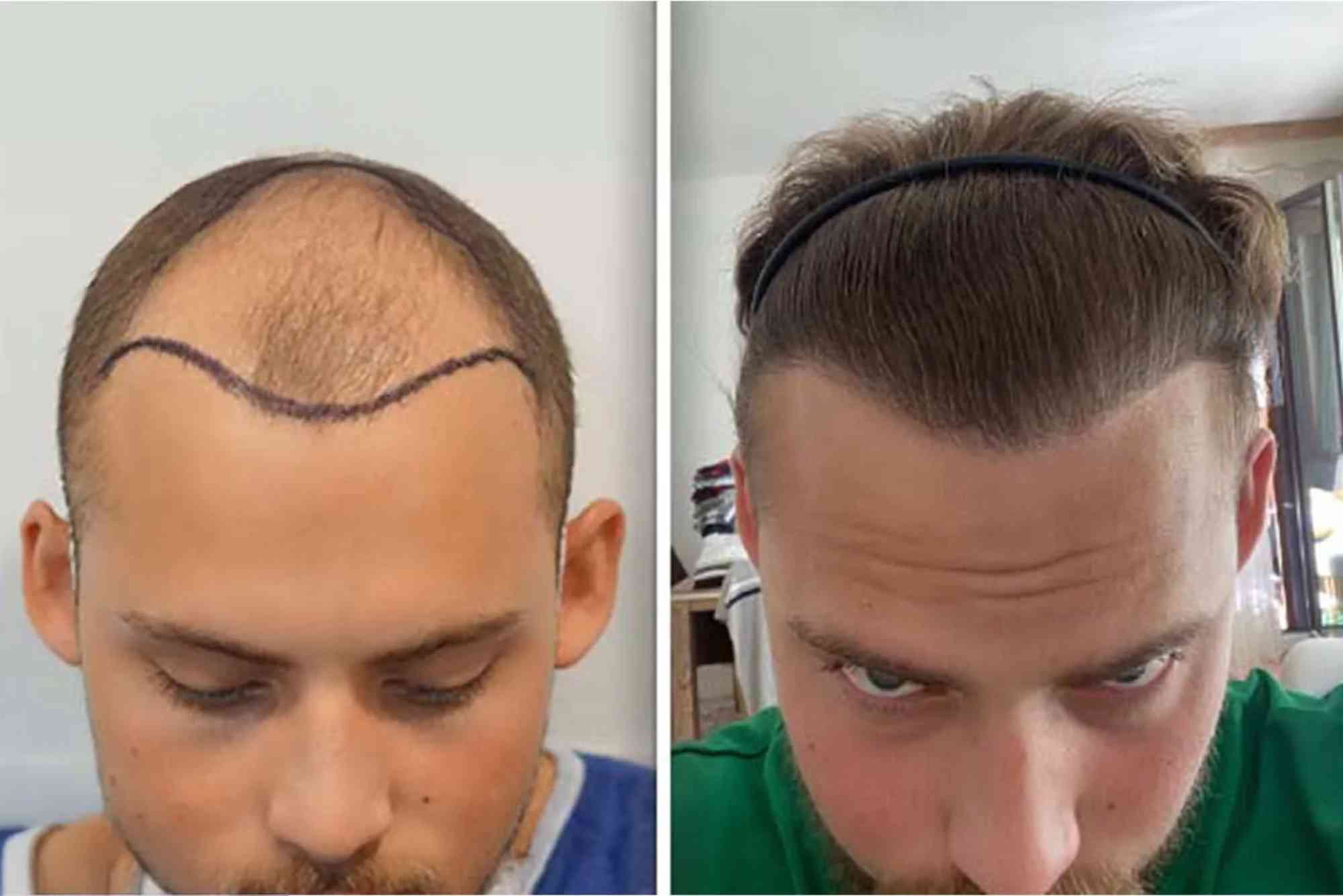 Best Hair Transplat Turkey
